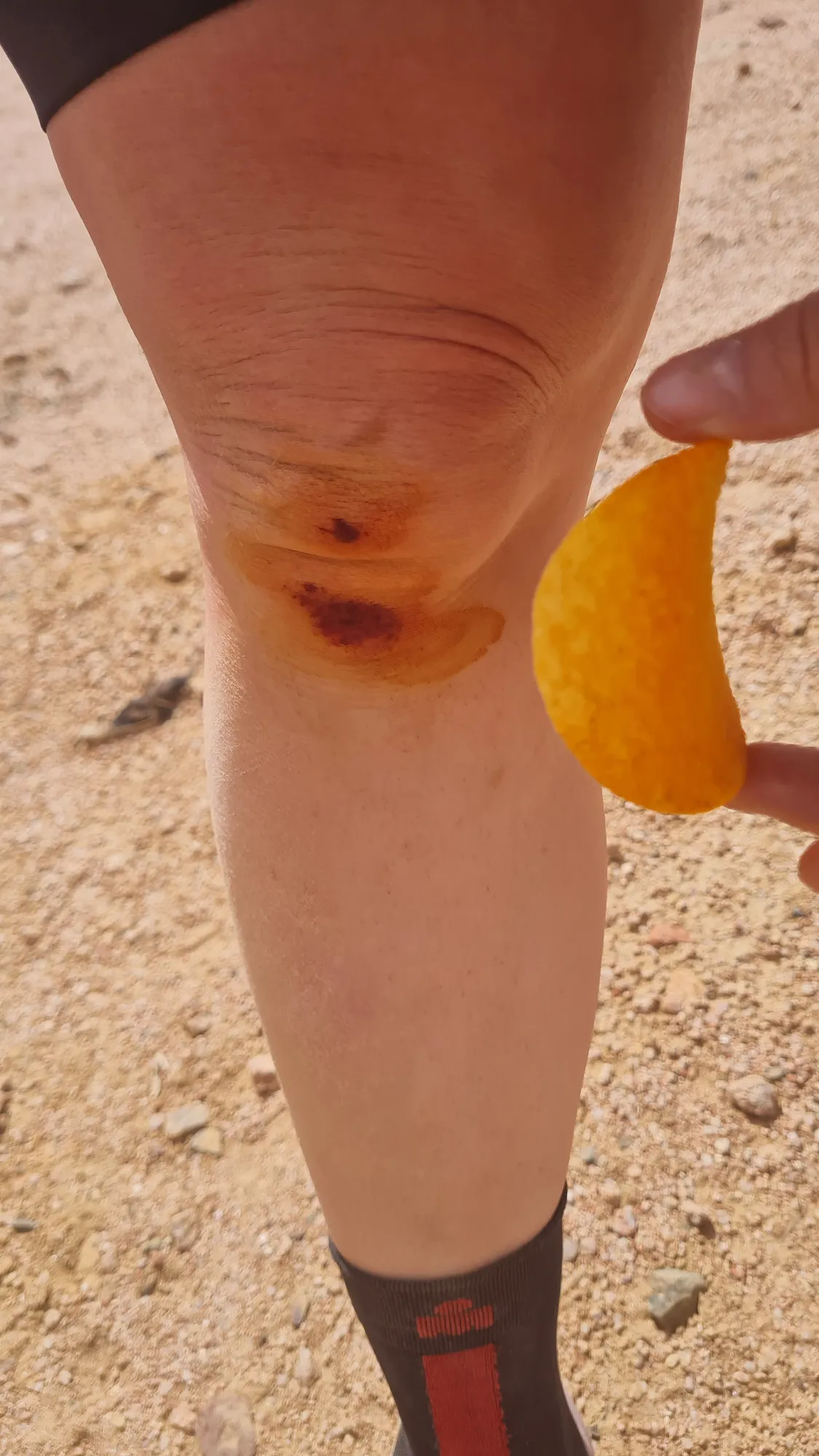 Aufgeschürftes Knie nach dem Sturz in den Sand